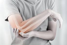 Thay khớp khuỷu tay là gì? - quy trình thực hiện và hồi phục sức khỏe
